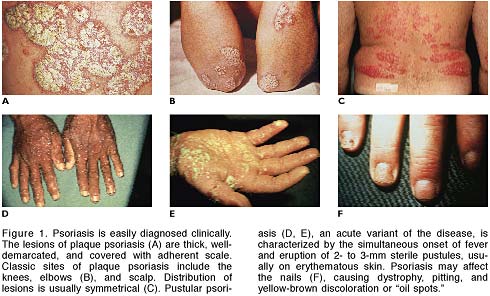 vClinical Features and Complications. Contributed by Dr.Balachandran,Dubai